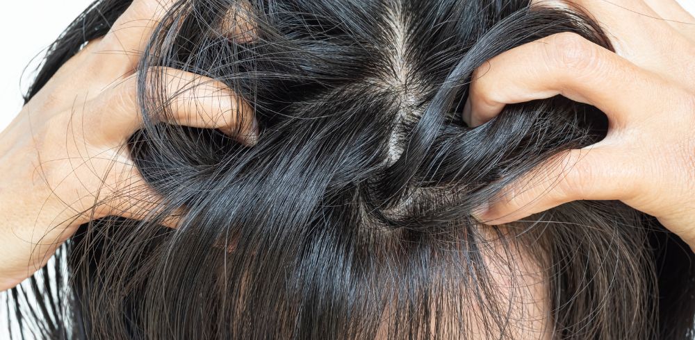 Schuppen verstehen & kontrollieren: Ursachen, Pflege & effektive Lösungen